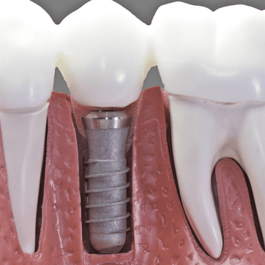 Clínica Dental S'Alamera prótesis dental