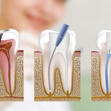 Clínica Dental S'Alamera endodoncia 